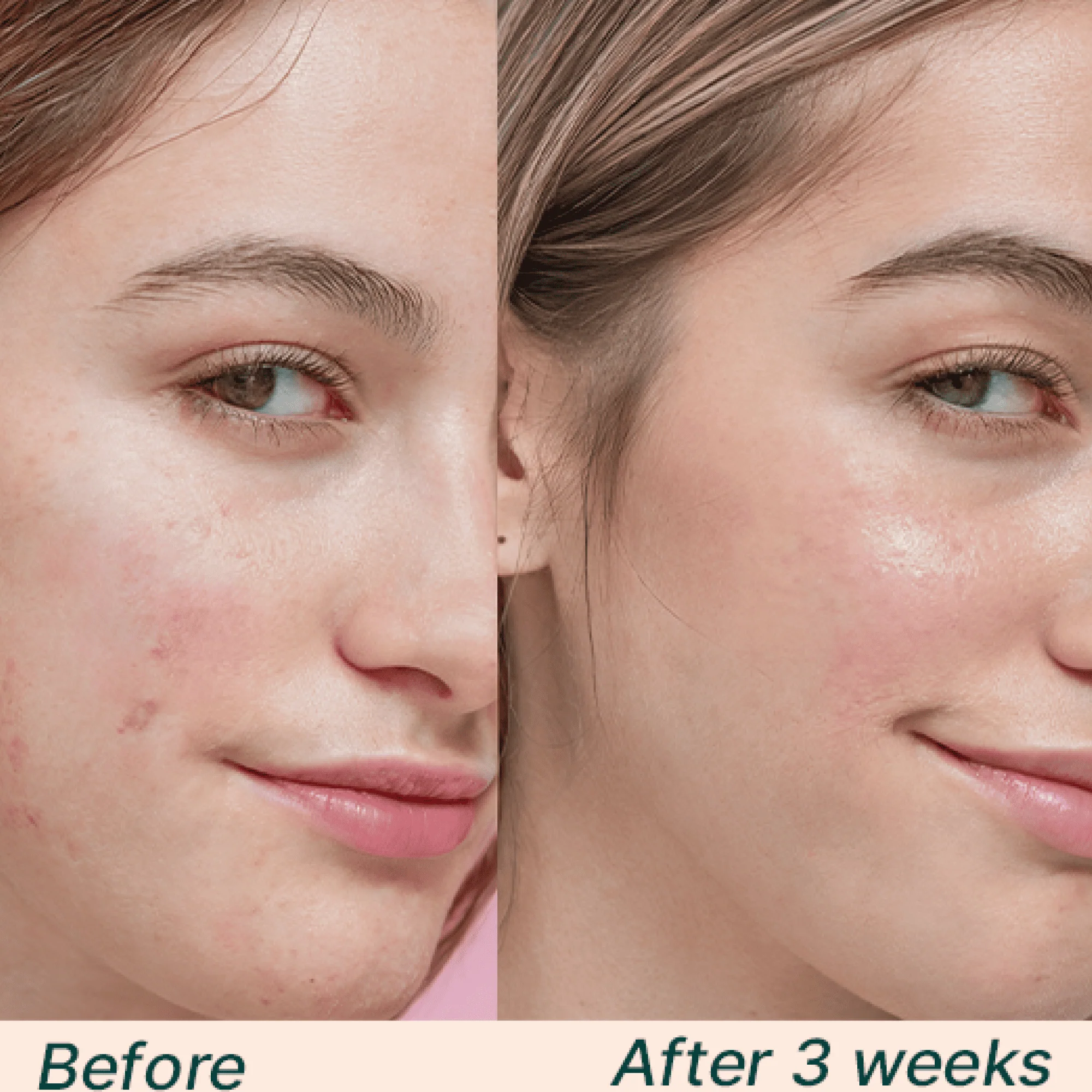 Hyaluronic Acid Quad Bundle - Image 2